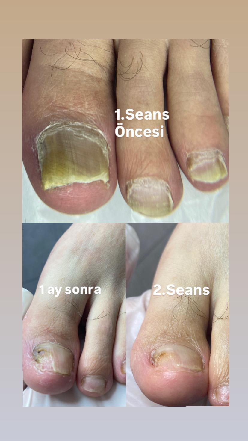 ONİKOMİKOZ (MANTAR TEDAVİSİ) 